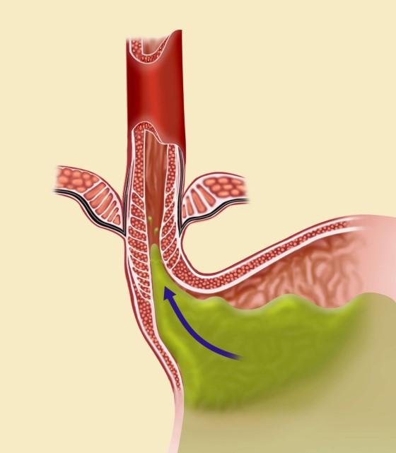GERD syndrom, což je těžší forma pálení žáhy, kdy se častěji vyskytuje regurgitace, při níž se žaludeční tekutiny dostávají do krku
